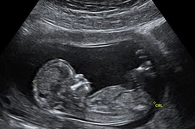 Ultrasound
